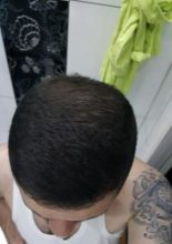 dr-kul-hair-transplant (28)