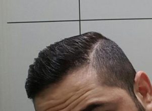 dr-kul-hair-transplant (29)