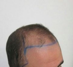 dr-kul-hair-transplant (3)