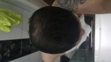 dr-kul-hair-transplant (30)