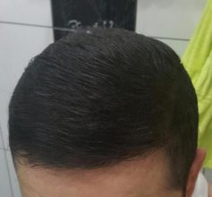 dr-kul-hair-transplant (31)