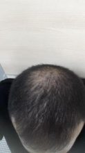 dr-kul-hair-transplant (33)