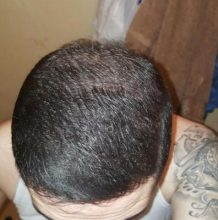 dr-kul-hair-transplant (34)