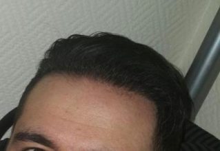dr-kul-hair-transplant (36)