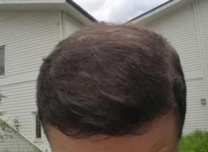 dr-kul-hair-transplant (40)