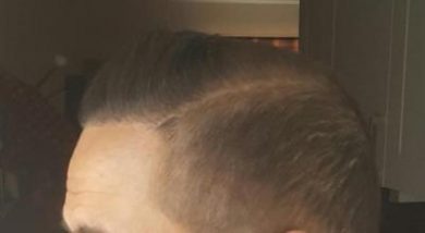 dr-kul-hair-transplant (5)