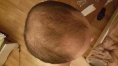 dr-kul-hair-transplant (7)