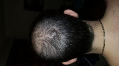 dr-kul-hair-transplant (8)