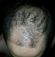 dr-kul-hair-transplant (9)