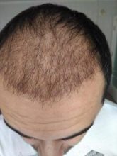 hair-transplant-antalya (11)