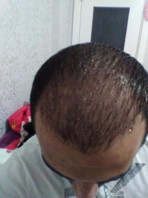 hair-transplant-antalya (12)