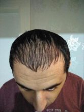 hair-transplant-antalya (13)