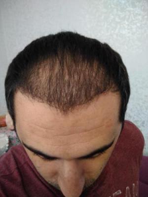 hair-transplant-antalya (14)