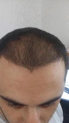 hair-transplant-antalya (15)