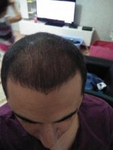 hair-transplant-antalya (17)