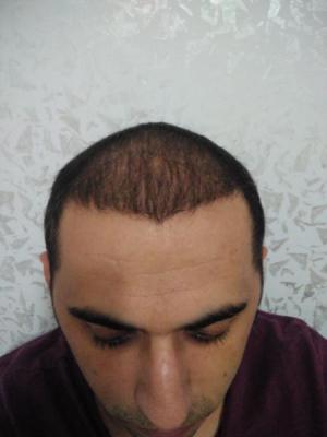 hair-transplant-antalya (18)