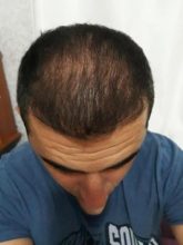 hair-transplant-antalya (19)