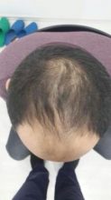 hair-transplant-antalya (2)