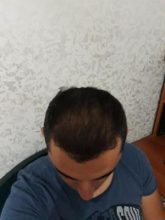 hair-transplant-antalya (20)