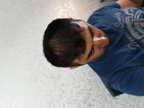 hair-transplant-antalya (22)