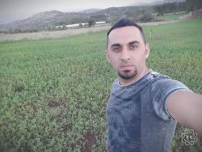 hair-transplant-antalya (23)