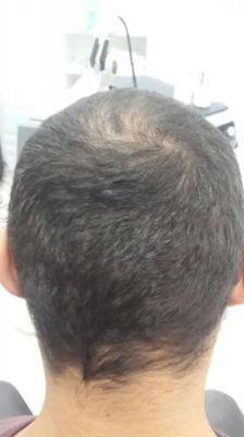hair-transplant-antalya (3)
