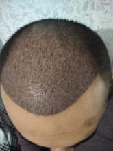 hair-transplant-antalya (4)