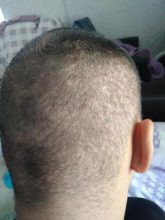 hair-transplant-antalya (8)