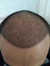 hair-transplant-antalya (9)