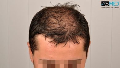 hair-transplant-turkey-asmed
