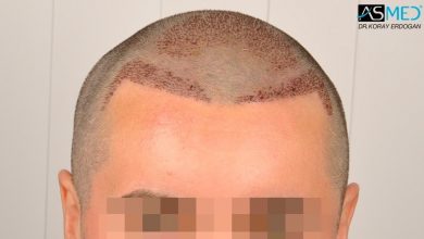 hair-transplant-turkey-asmed