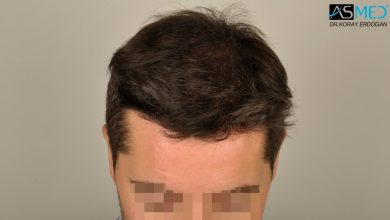 hair-transplant-turkey-asmed