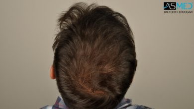 hair-transplant-turkey-asmed