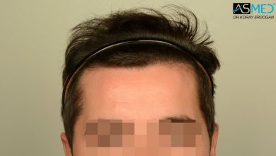 hair-transplant-turkey-asmed