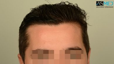 hair-transplant-turkey-asmed