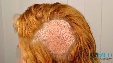 women-hair-transplant (1)