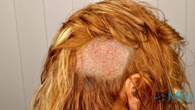 women-hair-transplant (2)