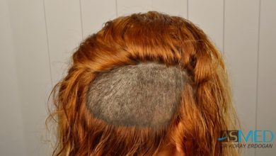 women-hair-transplant (3)