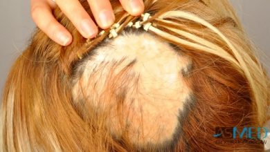 women-hair-transplant (7)