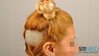 women-hair-transplant (8)