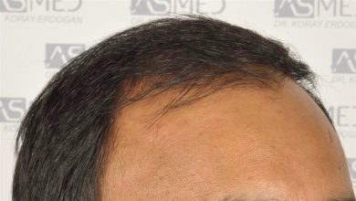 best-hair-transplant-in-turkey (10)