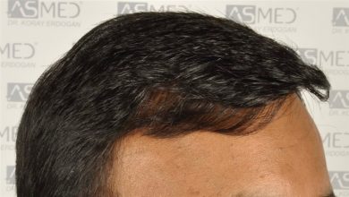 best-hair-transplant-in-turkey (13)