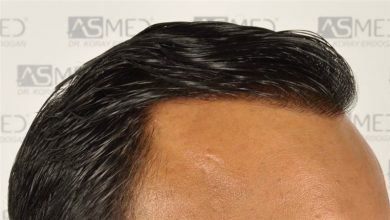 best-hair-transplant-in-turkey (14)
