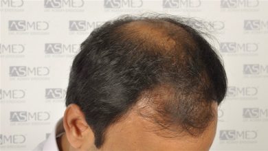 best-hair-transplant-in-turkey (15)