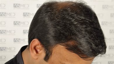 best-hair-transplant-in-turkey (18)