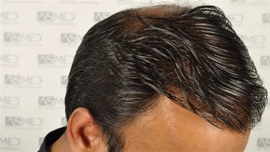 best-hair-transplant-in-turkey (19)
