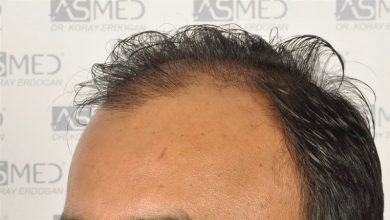 best-hair-transplant-in-turkey (21)