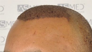 best-hair-transplant-in-turkey (22)