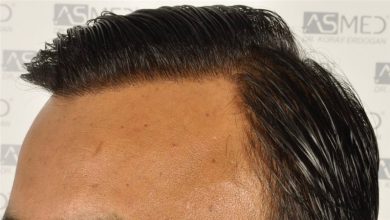 best-hair-transplant-in-turkey (24)