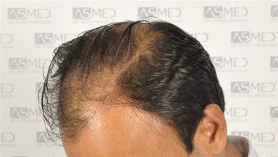 best-hair-transplant-in-turkey (26)